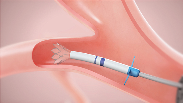 微小瓣膜可帮助某些肺气肿患者呼吸顺畅并避免手术