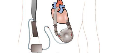 浅谈心力衰竭治疗手段的未来