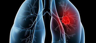 微创手术,女性早期肺癌治疗的“幸运之选” 微创手术,女性早期肺癌治疗的“幸运之选”